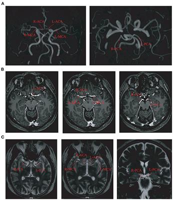 Cerebral Hemodynamic Evaluation of Main Cerebral Vessels in Epileptic Patients Based on Transcranial Doppler